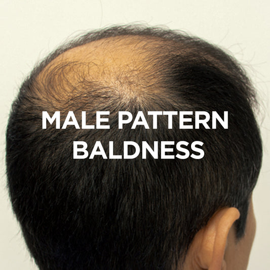 Male Pattern Baldness 