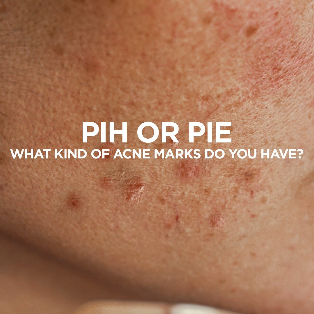 PIH OR PIE What kind of acne marks do you have? Soulflower.in