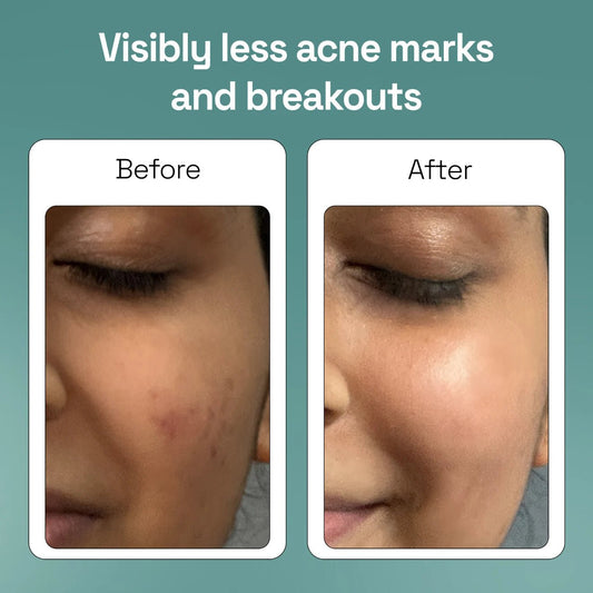 Glycolic Acid Acne & Zits Soap