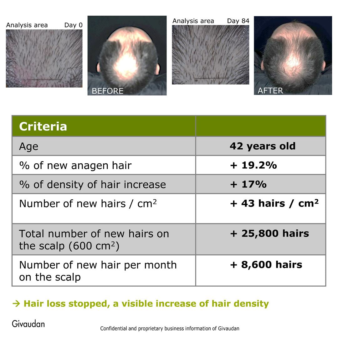 Stopped hair loss after using rosemary redensyl hair serum