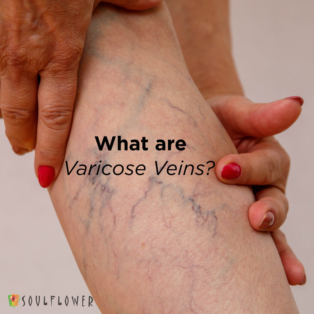 Varicose Veins