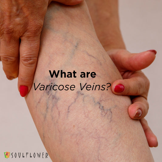 What is varicose veins?