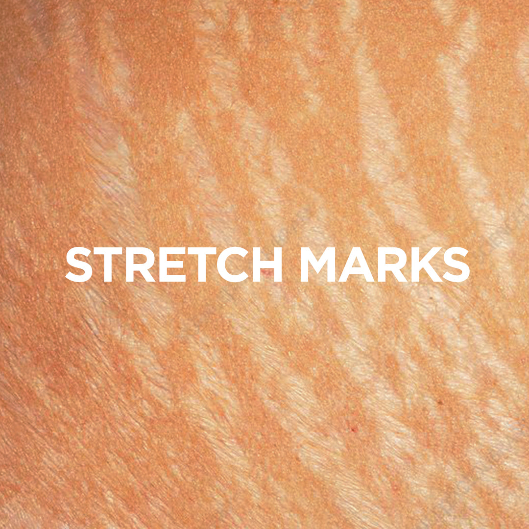 stretch marks 