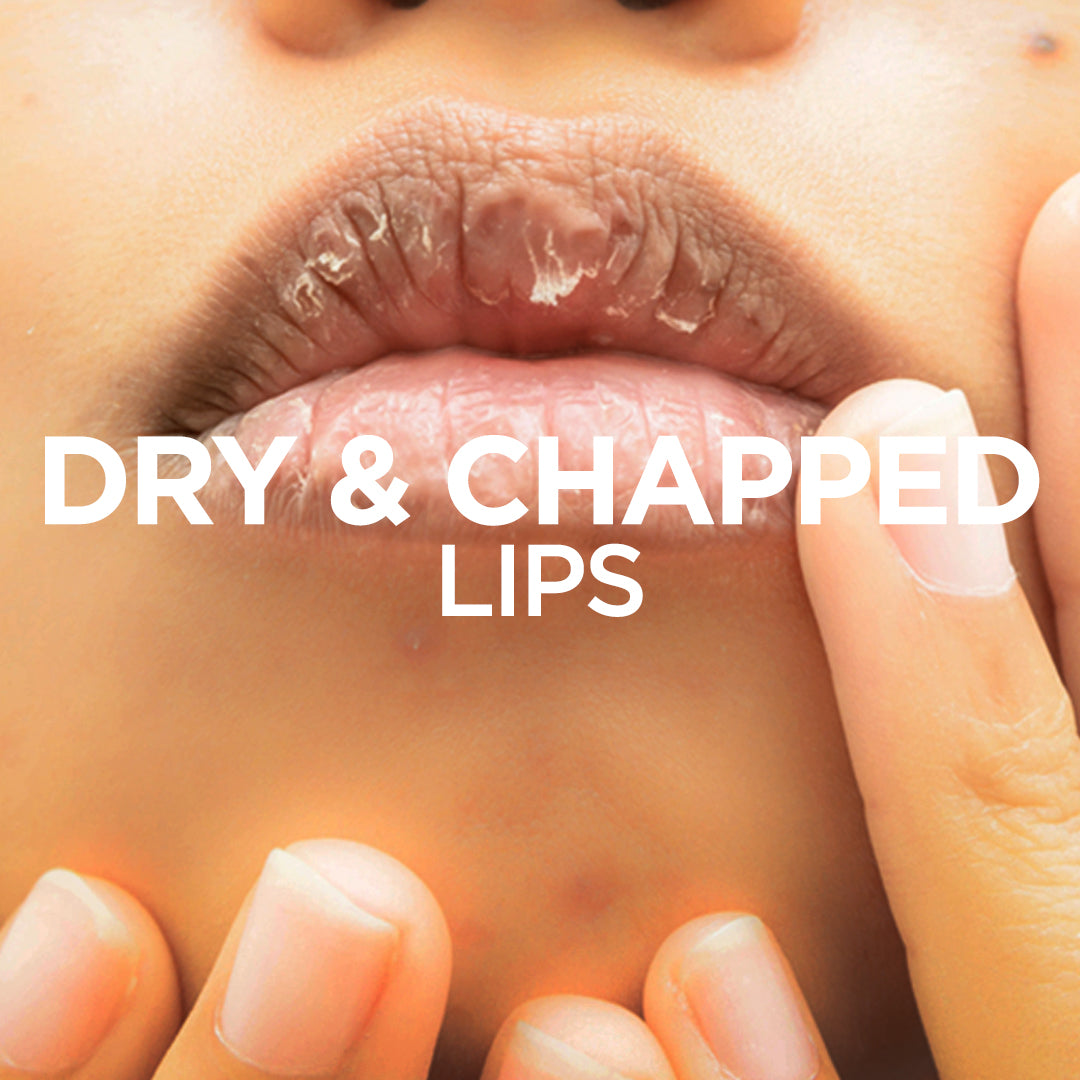 Dry & Chapped Lips