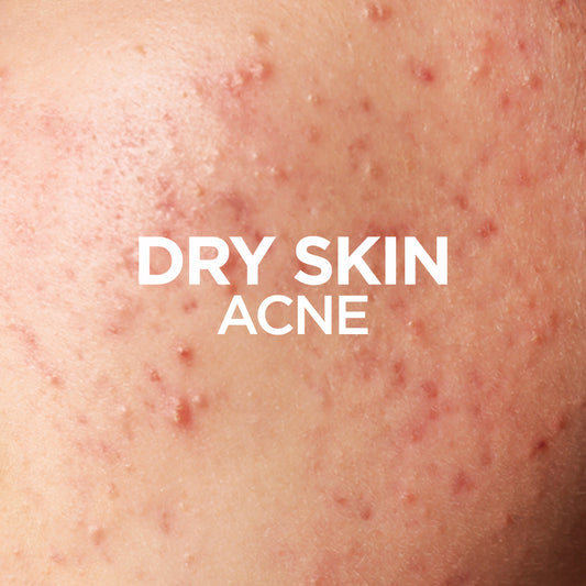 Dry Skin Acne