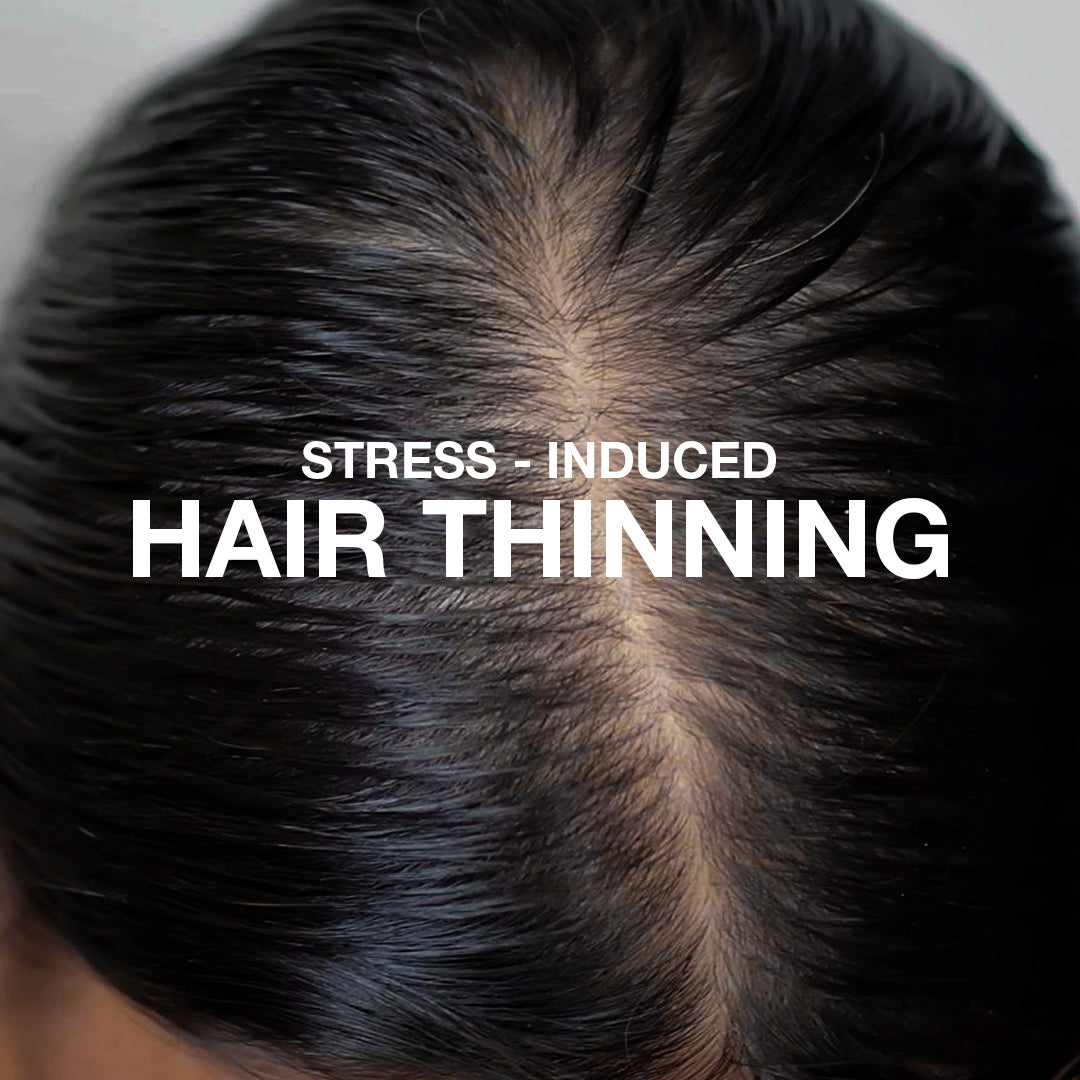 Stress Induced Hair Thinning? Here's What You Should Know!