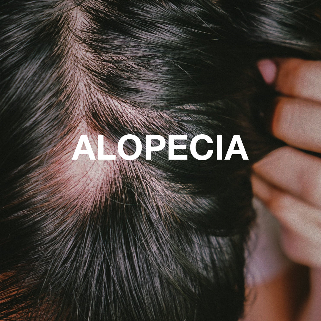 What To Know About Alopecia? Here's What You Should Not Skip!