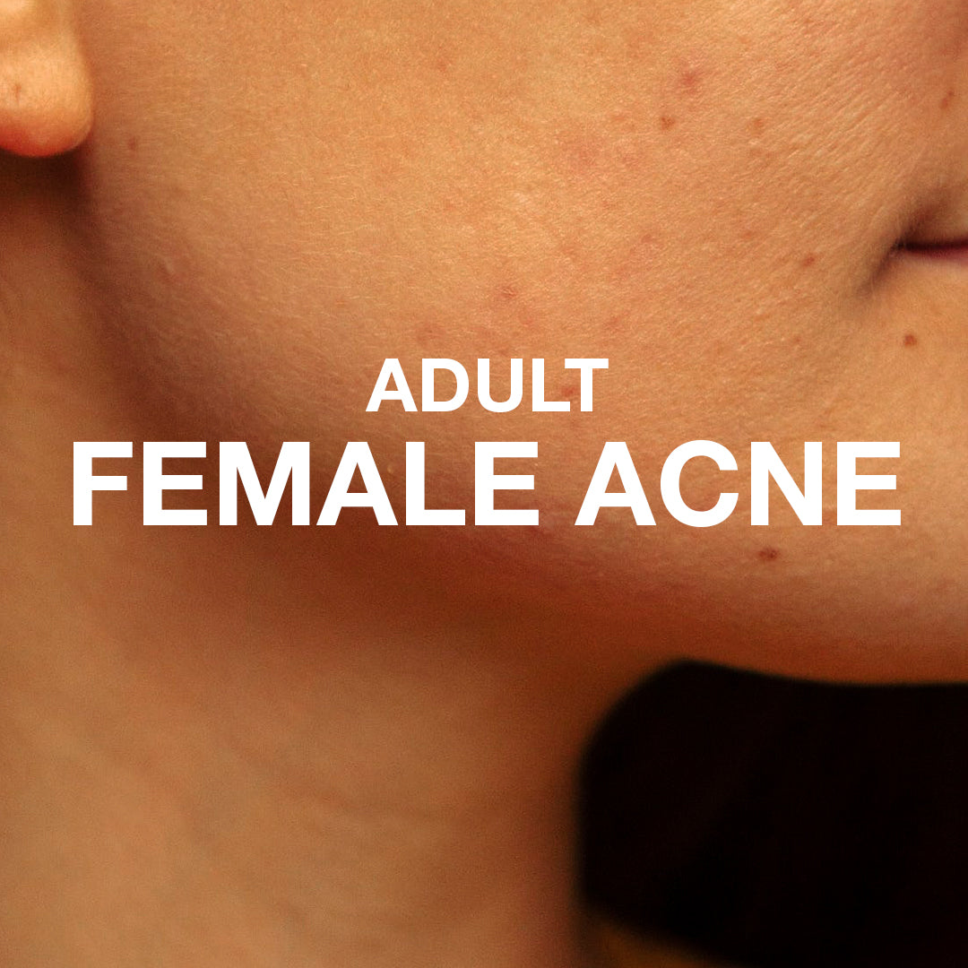 Adult Female Acne: Why It Happens & What Helps