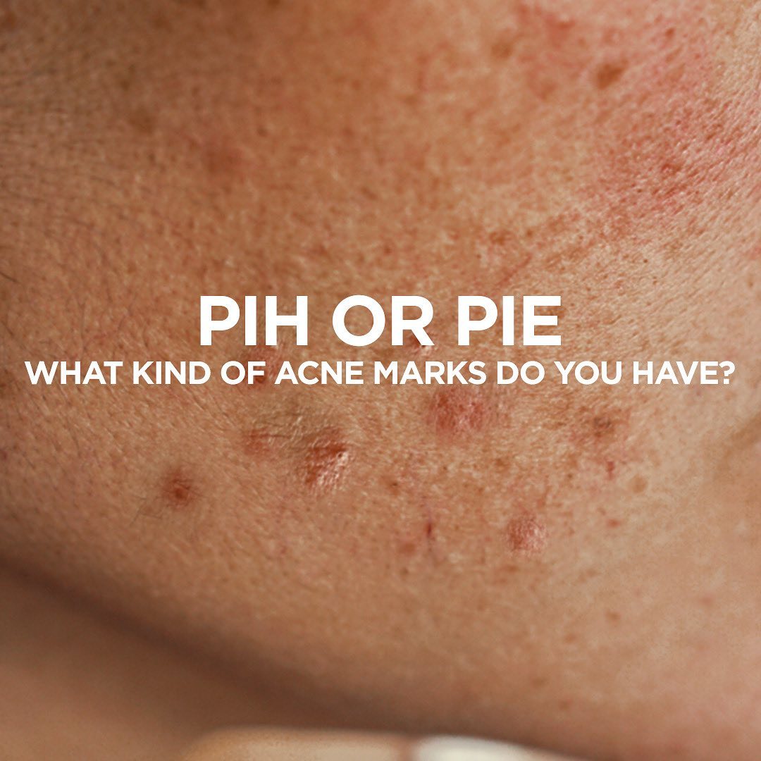 PIH OR PIE - What kind of acne marks do you have?