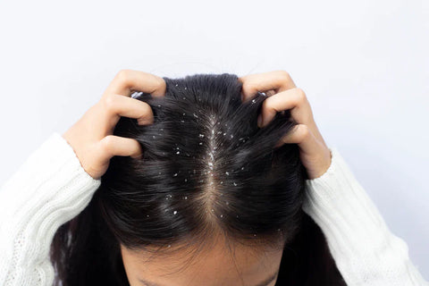 Top 13 Natural Remedies for Dandruff That Actually Work