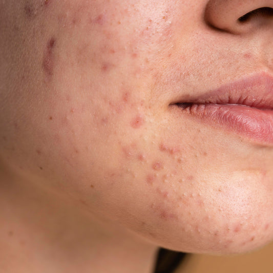 Do's and Don'ts for Acne: Tips for Clear and Healthy Skin