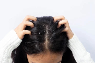 Top 6 Anti-Dandruff Ingredients to Avoid in 2025!