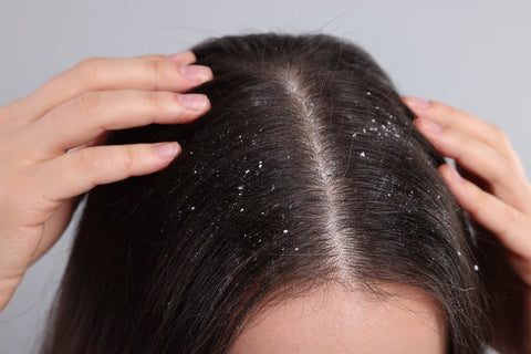 Top 13 Natural Remedies for Dandruff That Actually Work