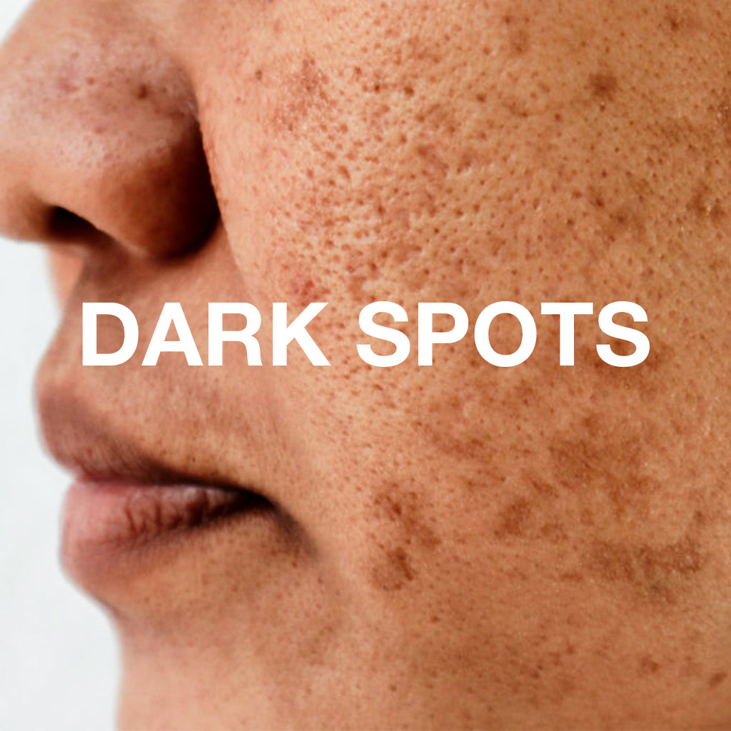 The Science Of Dark Spots