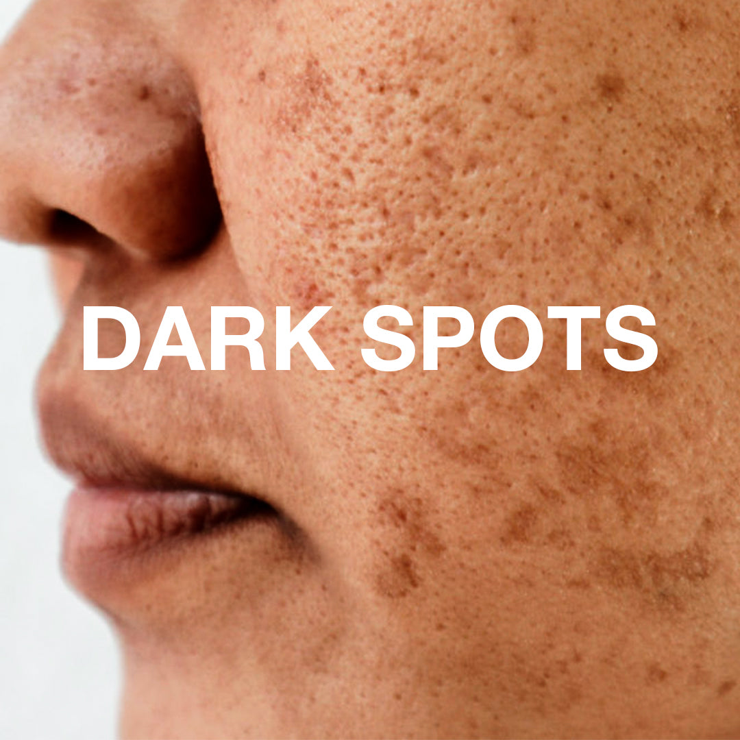 The Science Of Dark Spots | Causes & Remedies