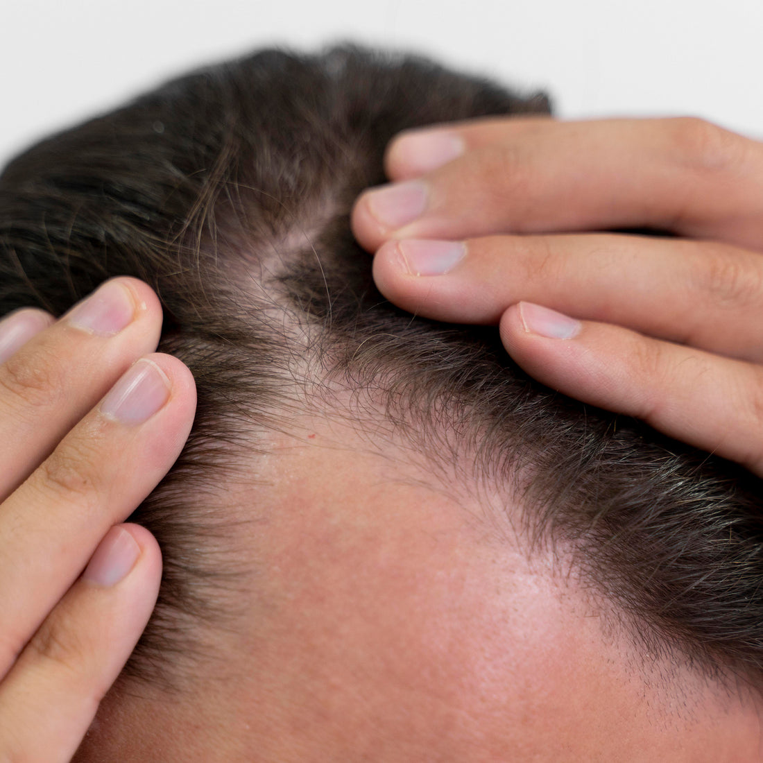 Image of a person with receeding hairline