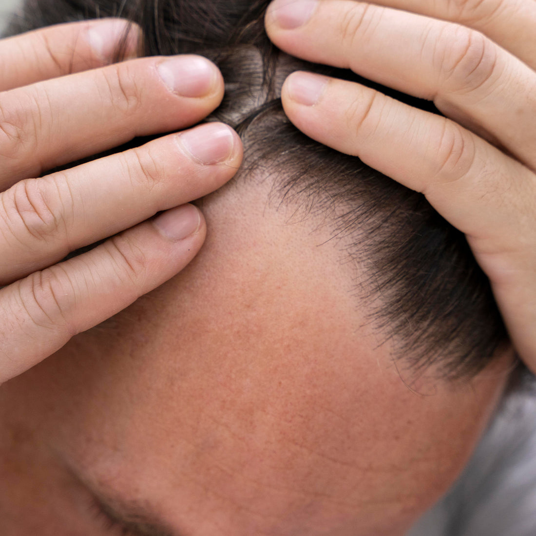 Image of a person showing his scalp acne