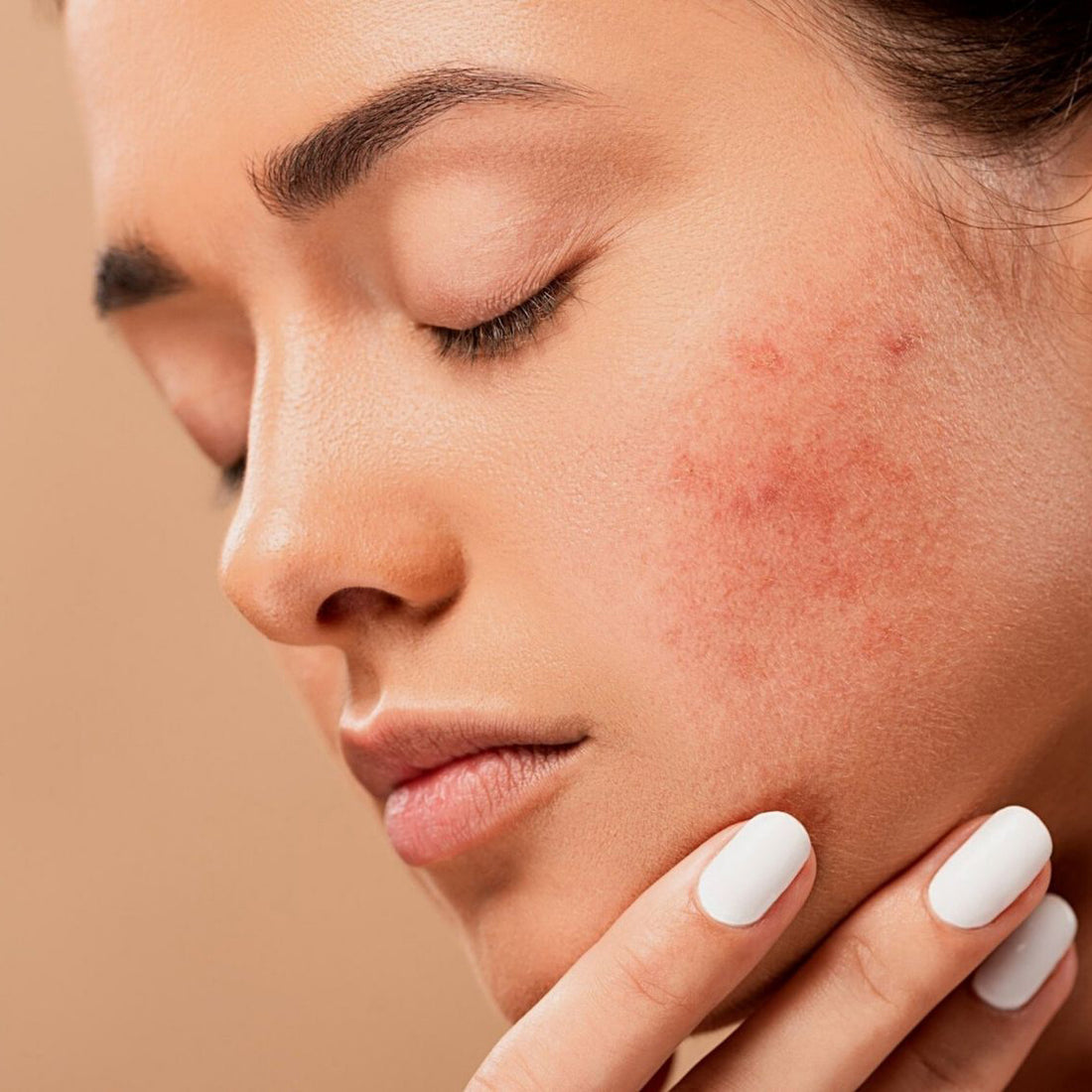 What Causes Stress Acne & What Helps!