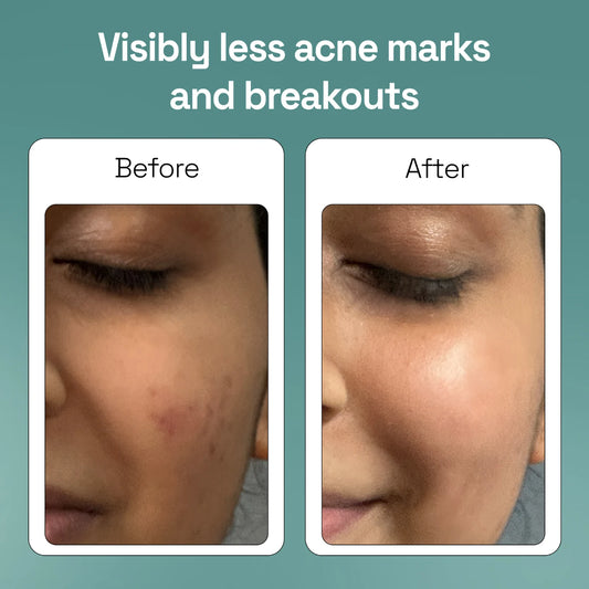 Glycolic Acid Acne & Zits Soap