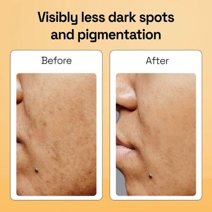 Kojic Acid Anti Pigmentation Kumkumadi Soap