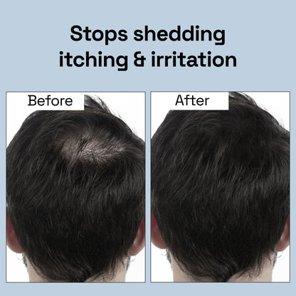 4-in-1 Daily Anti Shedding Dandruff Shampoo