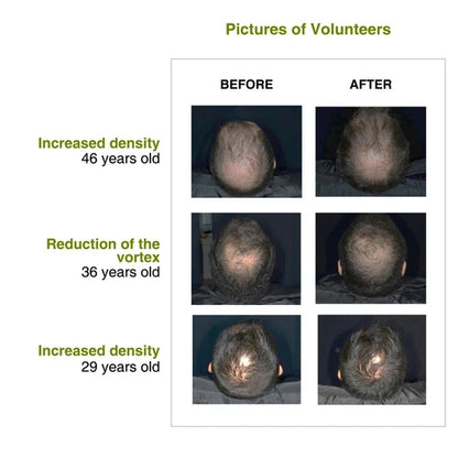 Increased hair density after using rosemary redensyl hair serum