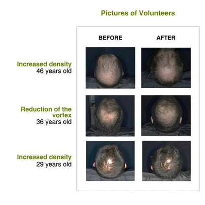 Increased hair density after using rosemary redensyl hair serum