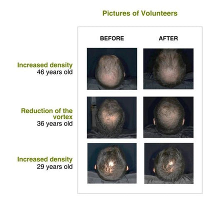Increased hair density after using rosemary redensyl hair serum