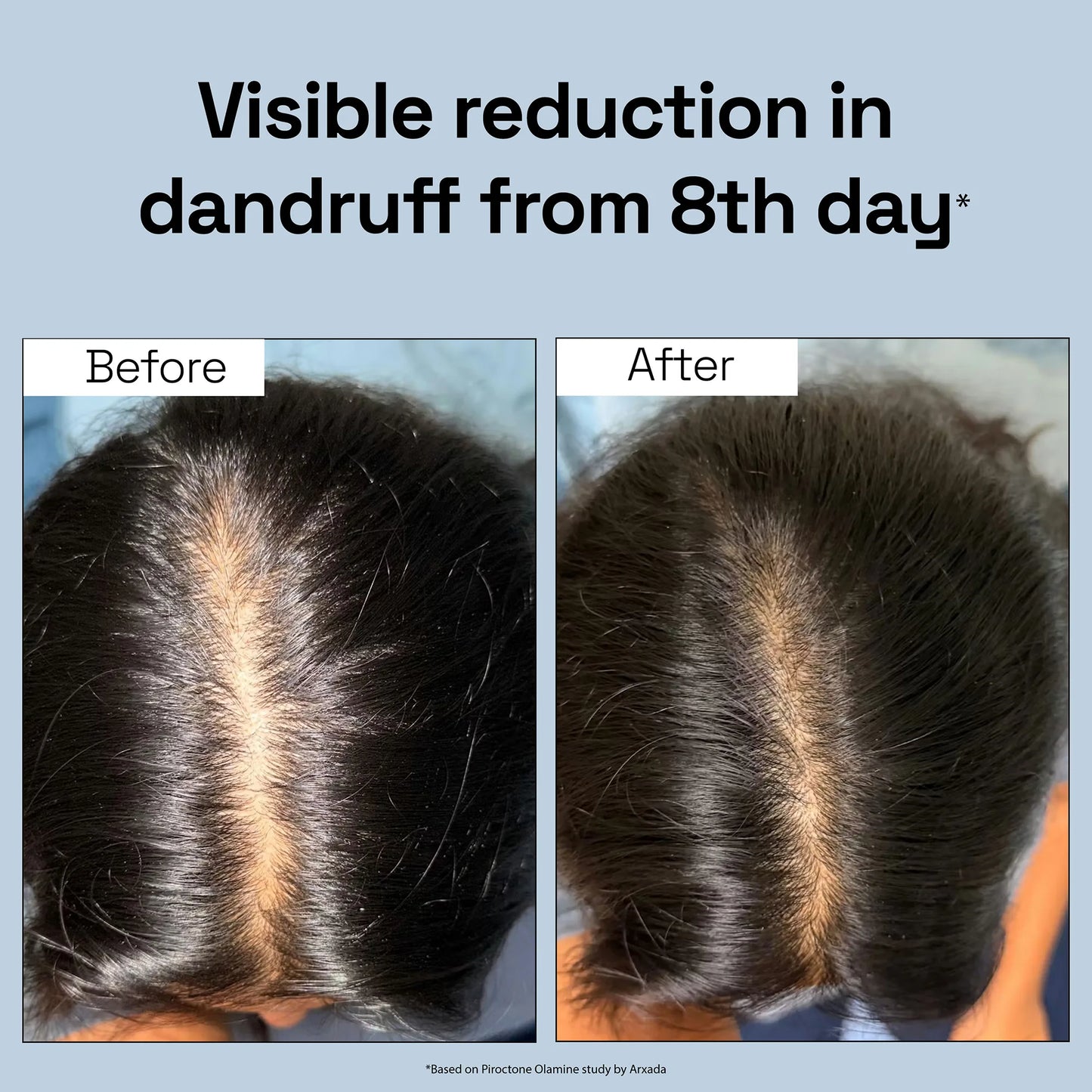 Intensive Anti Dandruff Serum