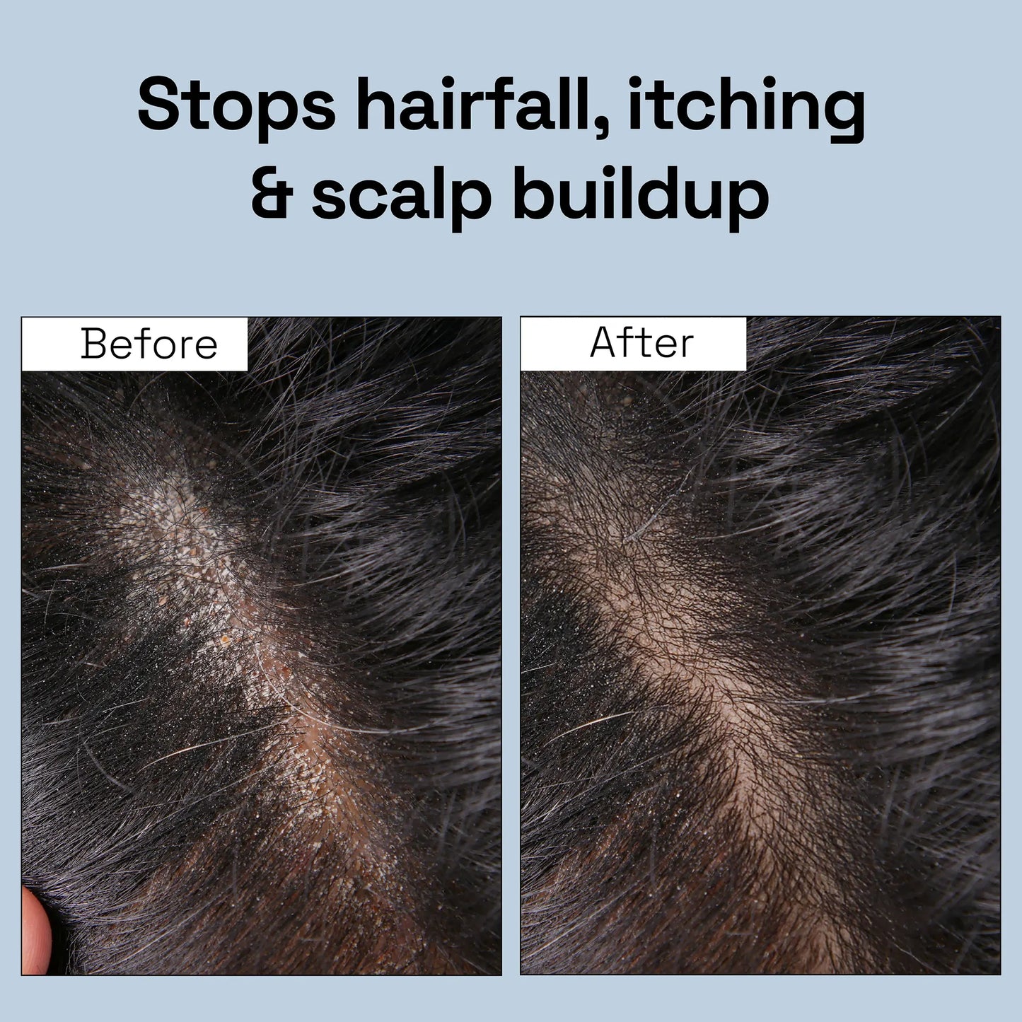 Intensive Anti Dandruff Serum