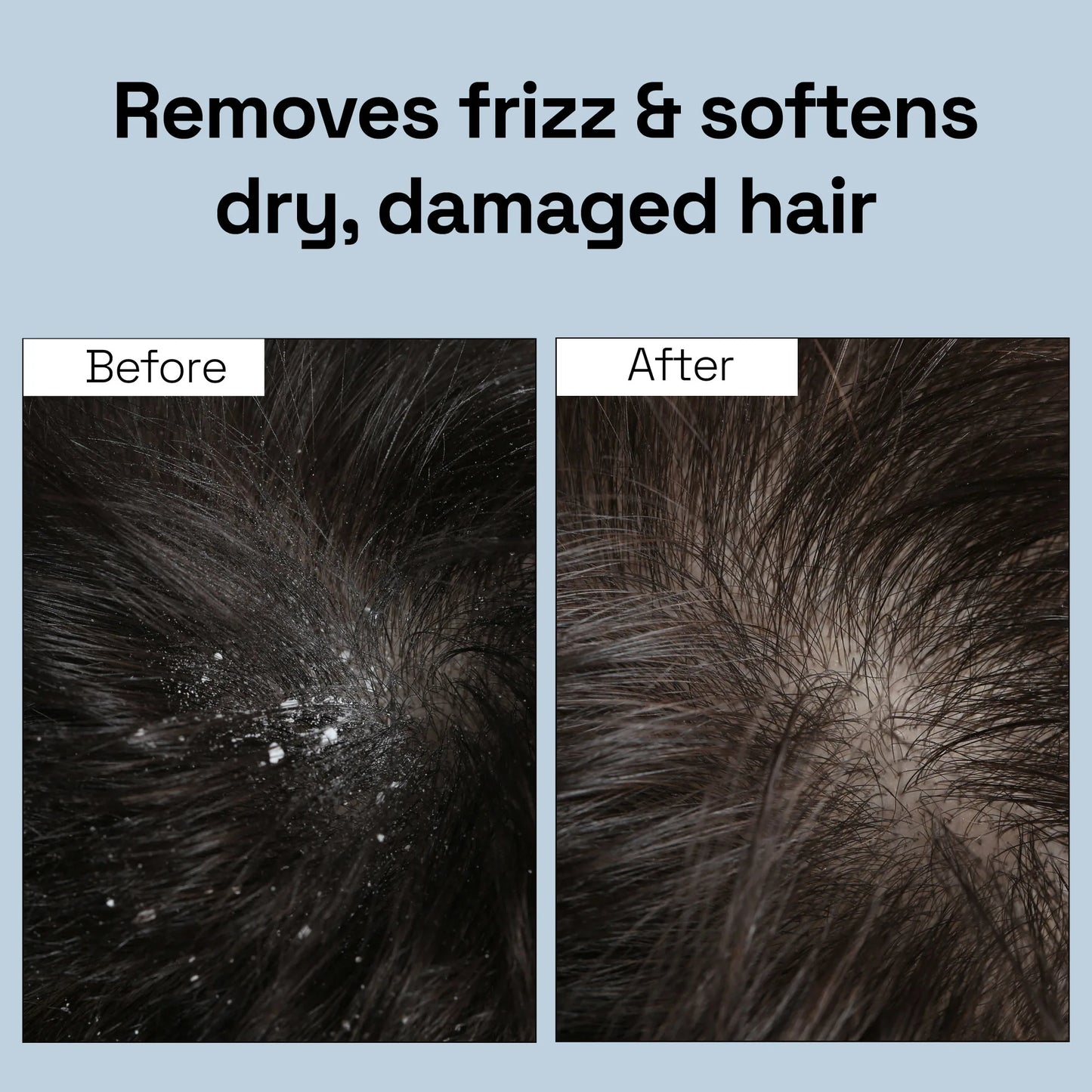 Tea Tree Anti Dandruff Scalp Oil